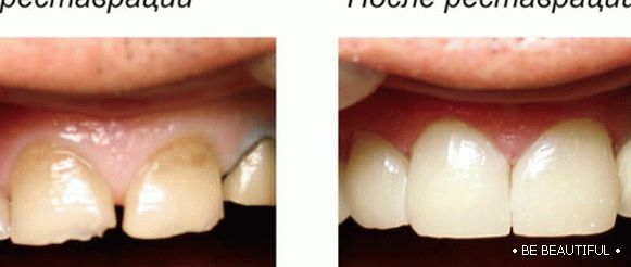 Възстановяване на криви зъби