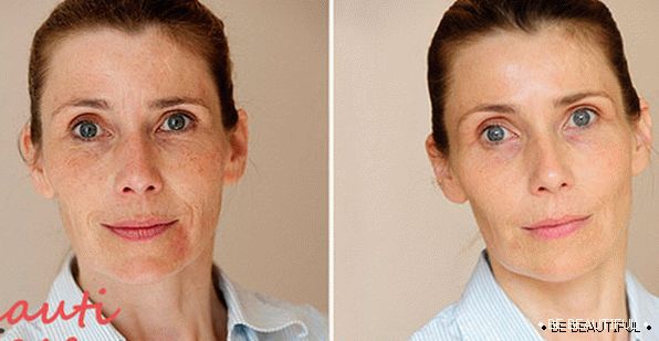 Ефект след подмладяване на лицето