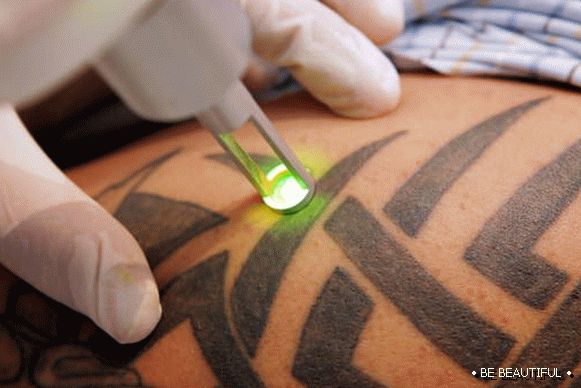 Поставяне на татуировка с лазер