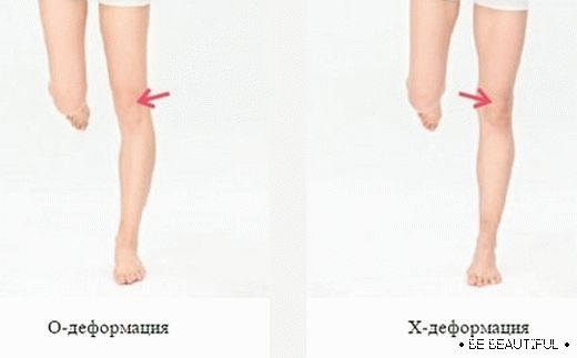 тест за отместване на коляното