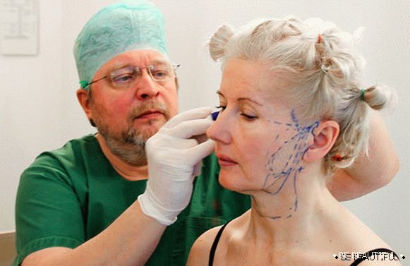 Маркиране на лицето преди процедурата за затягане
