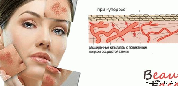 Лечение на розацеята на лицето